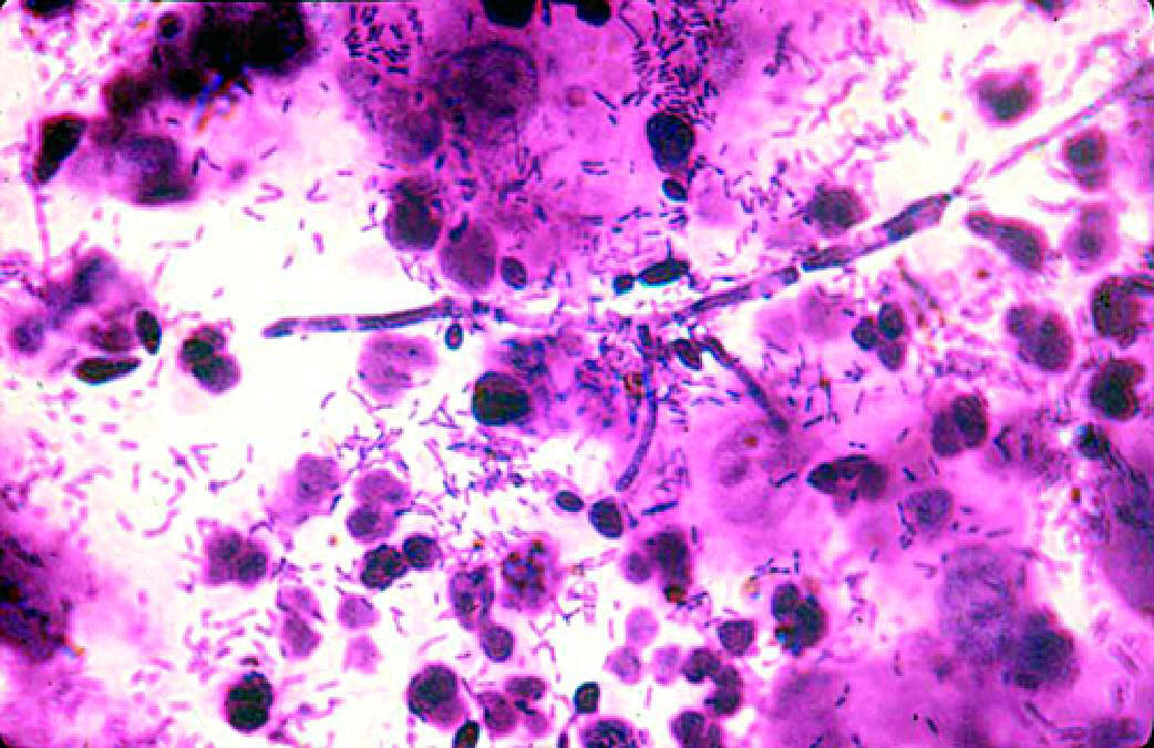 Кандидозный вагинит микроскопия мазка, окрашенного по Граму