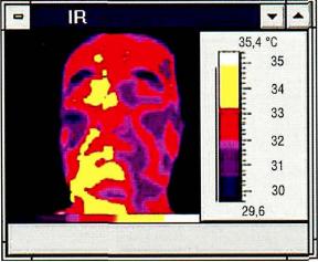 Рис. 12-4. Синдром Барракера-Симонса. Понижение инфракрасной активности на стороне гемифациоатрофии (термограмма).