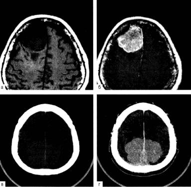 МРТ до (а) и после (б) внутривенного контрастного усиления выявляет менингиому правой лобной парасагиттальной области. КТ до (в) и после (г) контрастирования: большая менингиома.