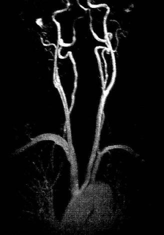 МР-ангиография с контрастным усилением. Магистральные сосуды головы от дуги аорты до большого круга основания мозга, вид спереди