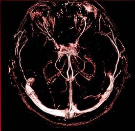 Рис. 3-9. МР-ангиография с контрастным усилением венозных образований ( венография) в полости черепа (3D-обработка).