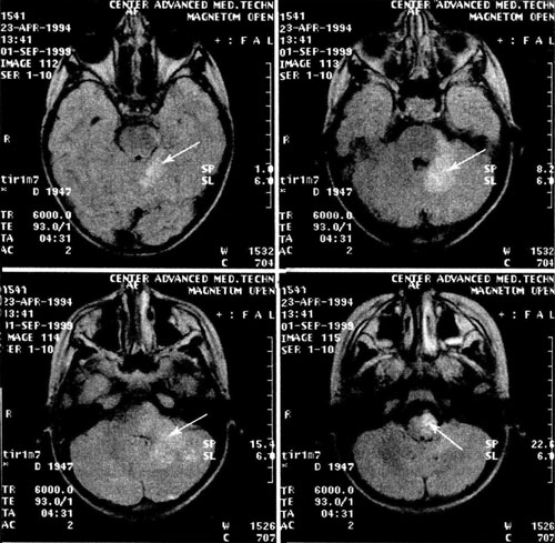 иксодовый клещевой боррелиоз с поражением ЦНС (энцефалит), острое течение. МРТ головного мозга (FLAIR). 