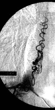 Суперселективная ангиограмма межрё6ерной артерии справа на уровне позвонка TVI при артериовенозной мальформации грудного отдела позвоночника