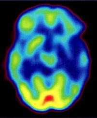 Рис. 5 - 2 . ПЭТ при болезни Альцгеймера. Билатеральный гипометаболизм в темен новисочных отделах головного мозга