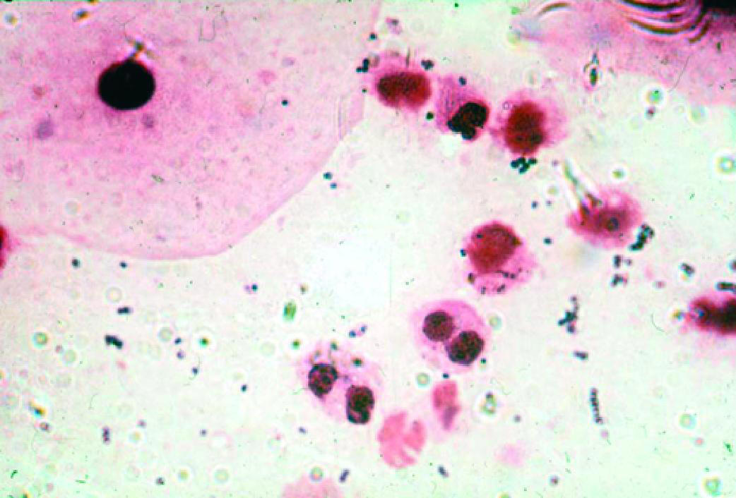 Неспецифический вагинит (микроскопия мазка, окрашенного по Граму).
