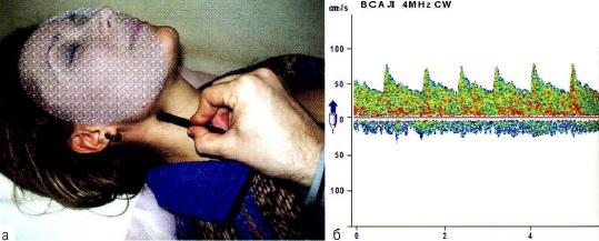 Рис. 11-3. Датчик в проекции локации внутренней сонной артерии (а). Спектр потока по неизменённой внутренней сонной артерии.