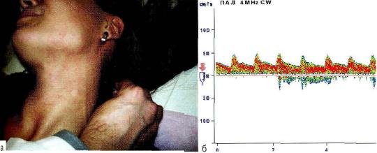 Рис. 11-б. Датчик в проекции локации позвоночной артерии (а), Спектр потока по неизменённой позвоночной артерии (б).