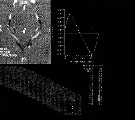 Фазово-контрастная МР-ликворография, динамическая серия изображений карт скоростей потока в сечении головного мозга на уровне водопровода мозга, изменение скорости потока в водопроводе мозга, таблица значений объёмной скорости